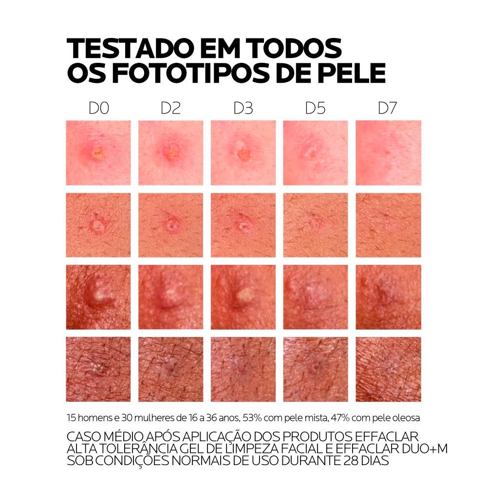 La Roche-Posay Effaclar Duo+ Gel Creme Facial Anti-Acne 40ml ÚNICO 9