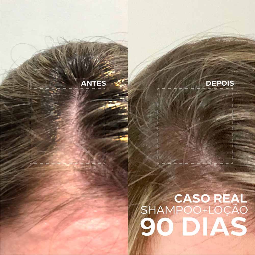 Loção Capilar Concentrada Ada Tina Amplexe Anti-Queda Tripla Ação 60ml 5